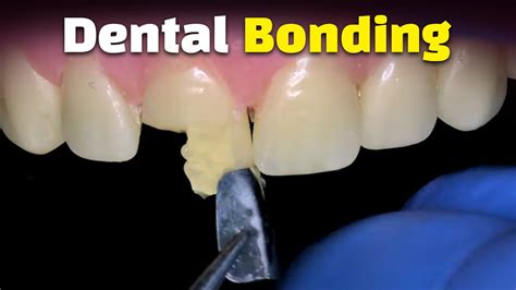 dental bonding burnsville mn|Bonding .